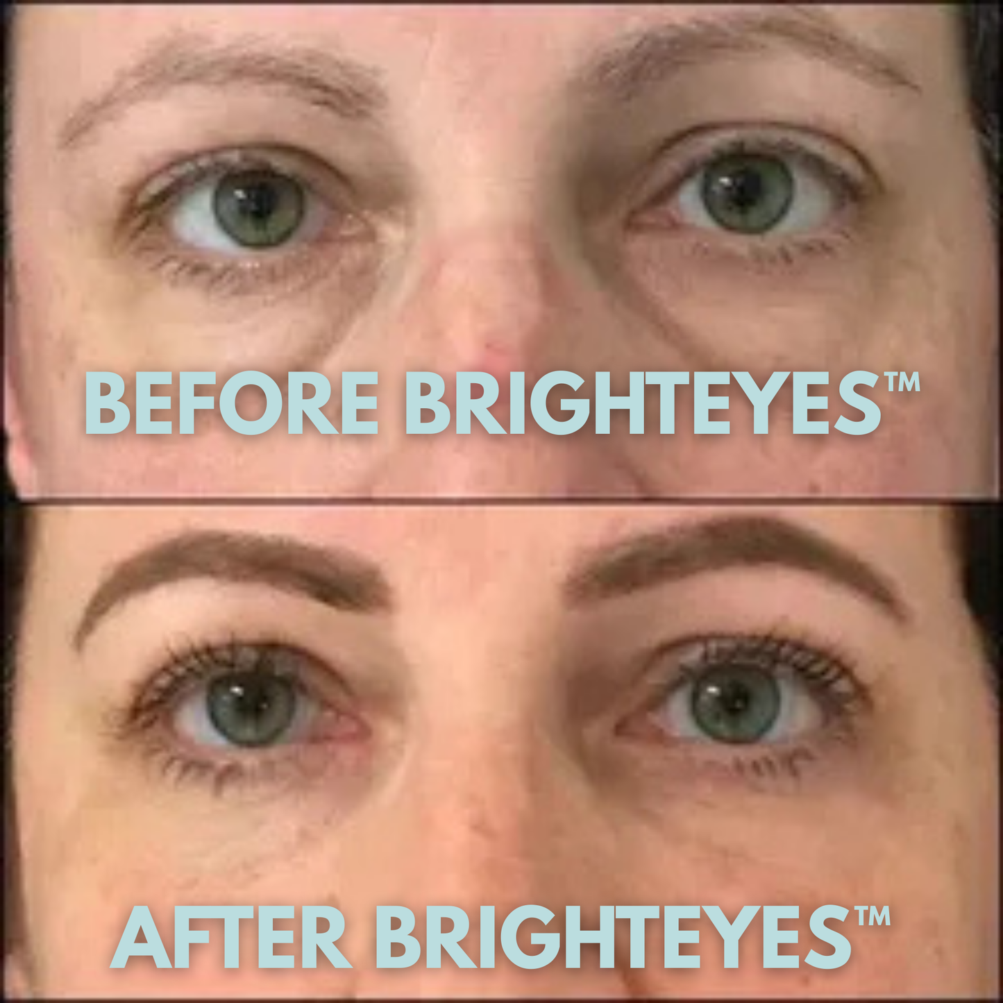 BrightEyes™ Under-Eye Red Light Therapy
